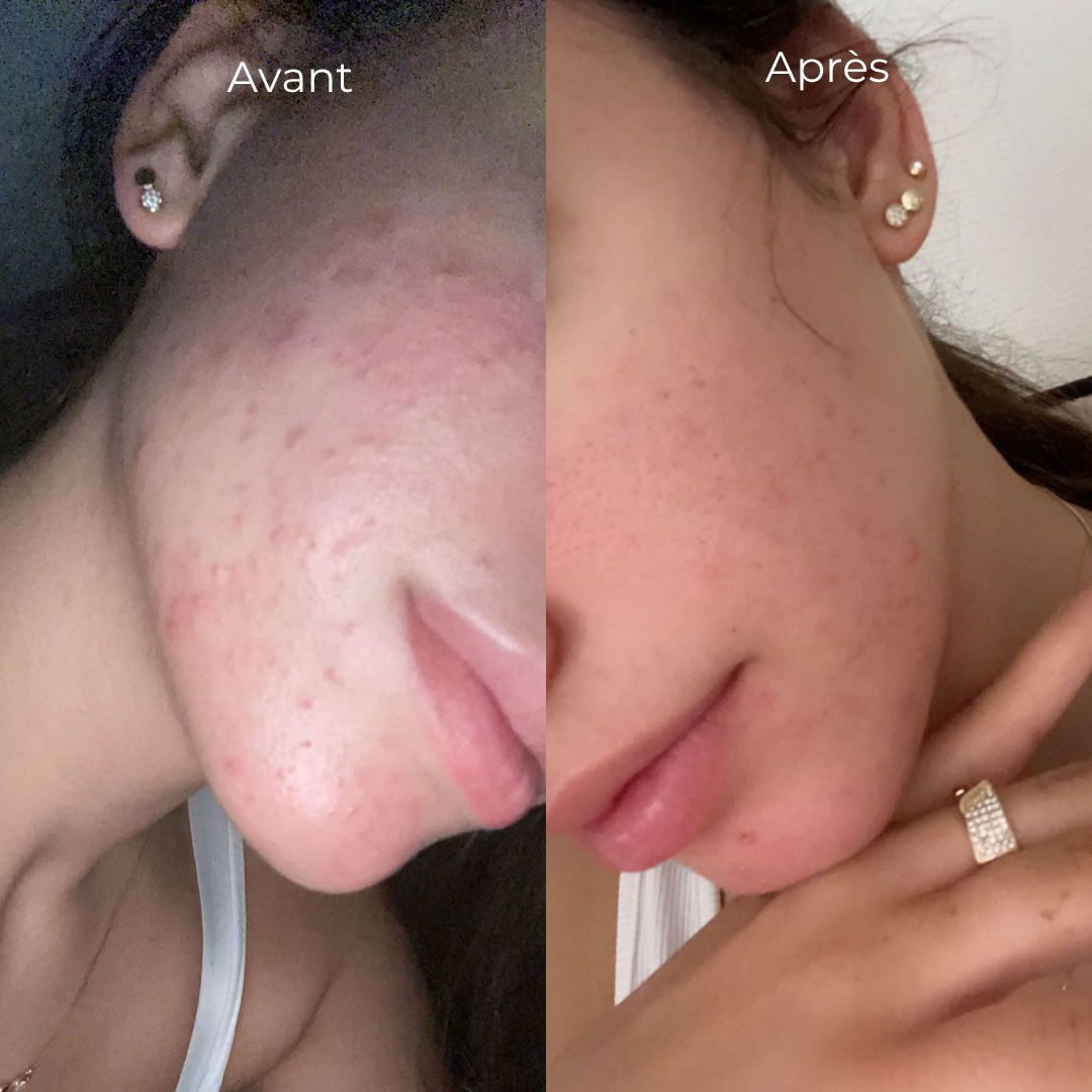 Routine anti-imperfections